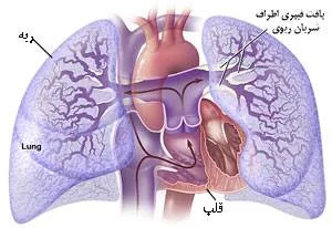 فشار خون ریوی