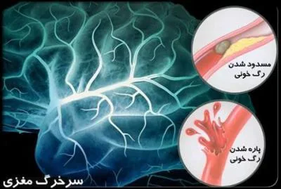 سکته مغزی