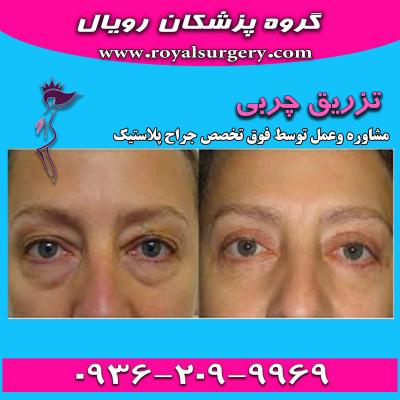  تزریق چربی به زیر چشم