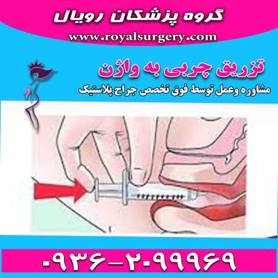  تزریق چربی به واژن