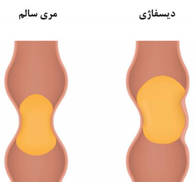  دیسفاژی یا احساس گیر کردن لقمه غذا