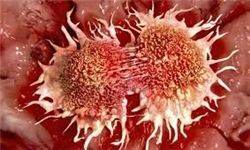  تشخیص سریع سرطان لوزالمعده