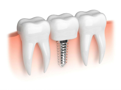  عوارض ایمپلنت دندان و نکات منفی آن چیست؟
