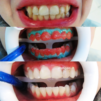  بلیچینگ دندانها