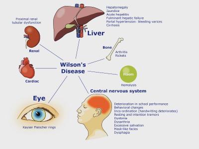  بیماری ویلسون