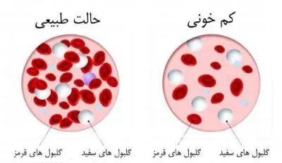 ۴ ماده مغذی جهت پیشگیری از کم خونی