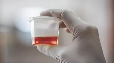 خون در ادرار و احتمالات پیش رو