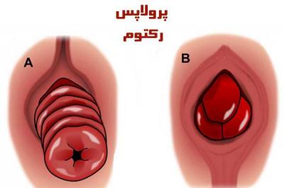  پرولاپس رکتوم