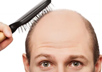 ریزش مو در آقایان از چه سنی آغاز می‌شود؟
