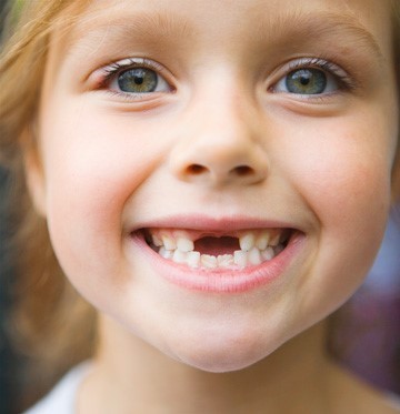  پوسیدگی دندان در کودکان
