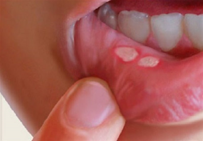  «عفونت دندان» باعث آسیب به چشم و مغز می شود