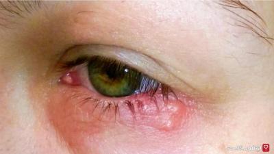  درباره شیوع عفونت‌های ویروسی چشم بیشتر بدانیم