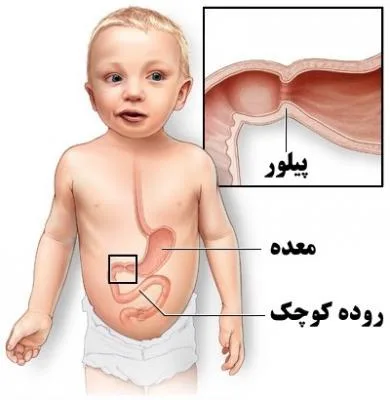تنگی پیلور در نوزادان و شیرخواران