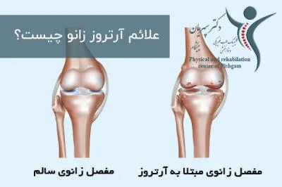 علائم آرتروز زانو چیست؟