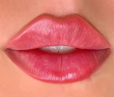 تزریق ژل لب مدل روسی
