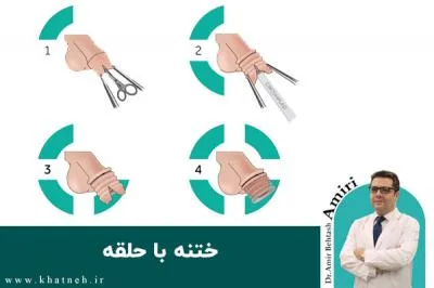 ختنه با حلقه
