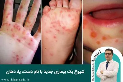 شیوع یک بیماری جدید با نام دست، پا، دهان