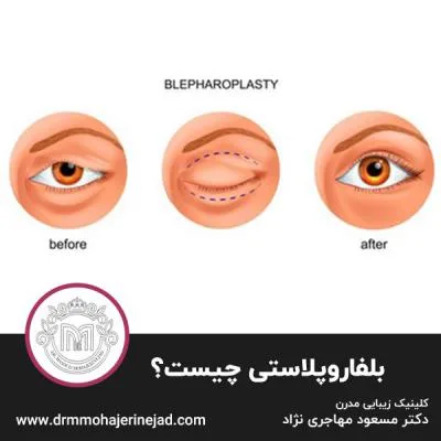 بلفاروپلاستی چیست؟