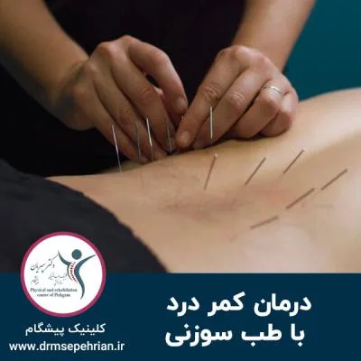 درمان کمر درد با طب سوزنی