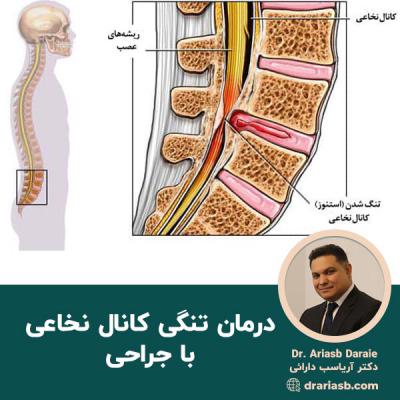  درمان تنگی کانال نخاعی با جراحی