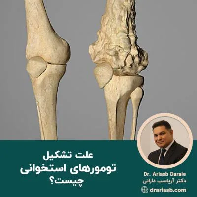 علل تشکیل تومورهای استخوانی چیست؟