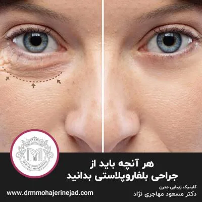 هر آنچه باید از جراحی بلفاروپلاستی بدانید