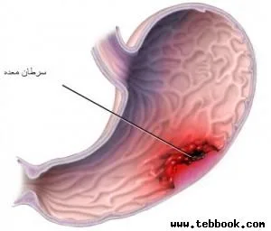 تصویر کاور جراحی چاقی لاپاروسکوپیک دکتر فریدی