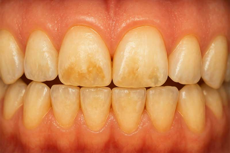  هیپوپلازی مینای دندان چیست؟