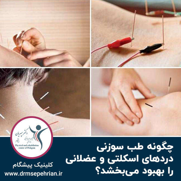  چگونه طب سوزنی دردهای اسکلتی و عضلانی را بهبود می‌بخشد؟