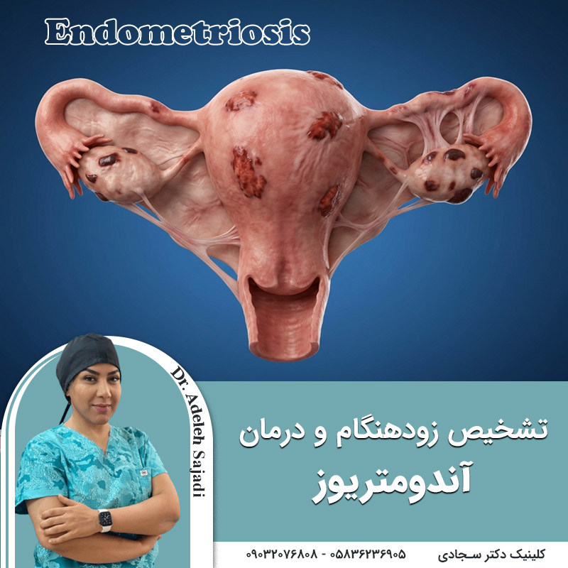  تشخیص زودهنگام و درمان های نوین آندومتریوز