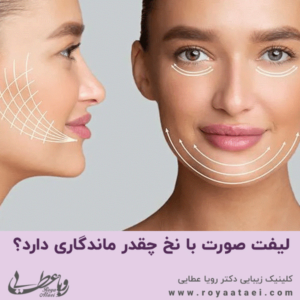  لیفت صورت با نخ چقدر ماندگاری دارد؟