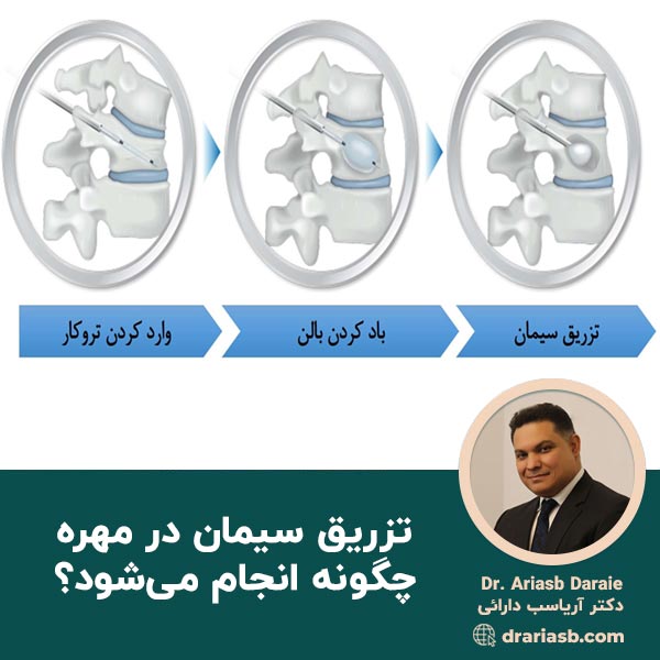  تزریق سیمان در مهره چگونه انجام می‌شود؟
