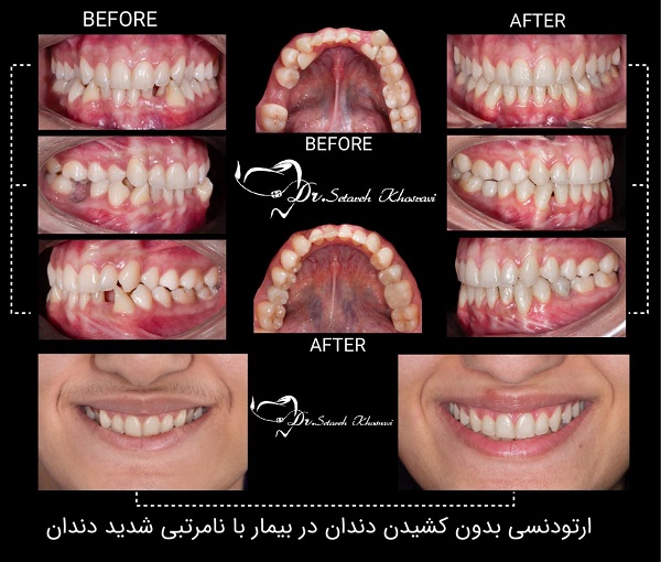  ارتودنسی بدون کشیدن دندان چیست و چطور انجام میشود ؟