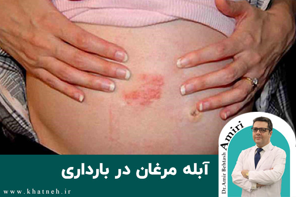  آبله مرغان در بارداری