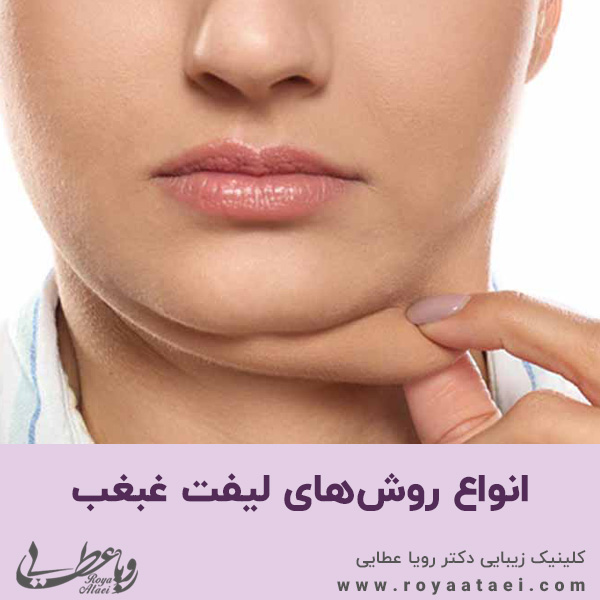 انواع روش های لیفت غبغب