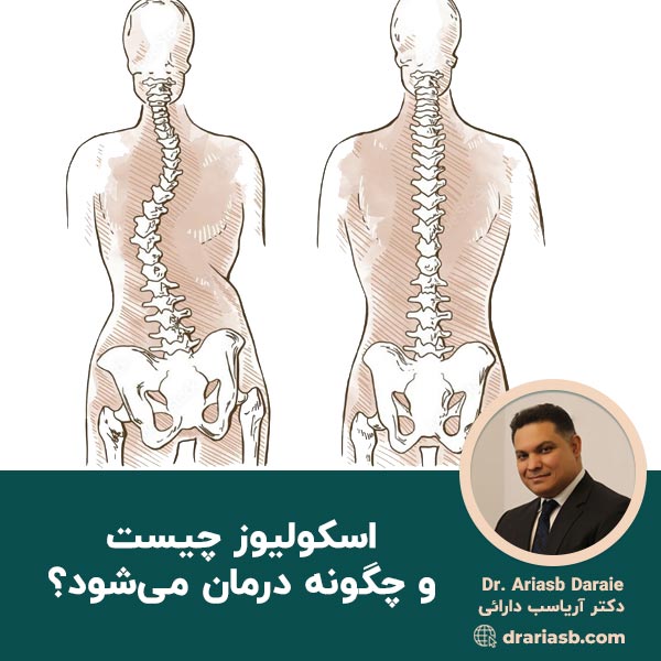  اسکولیوز چیست و چگونه درمان می‌شود؟