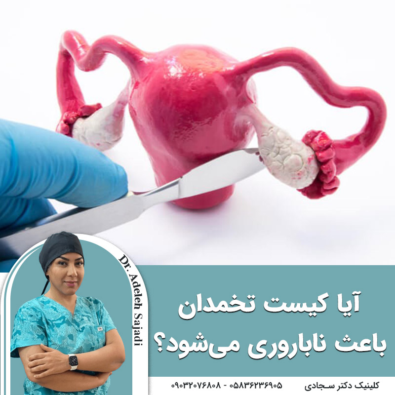  آیا کیست تخمدان باعث ناباروری می‌شود؟
