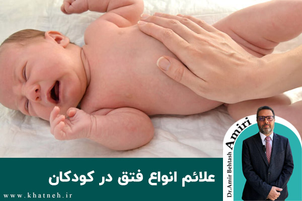  علائم انواع فتق در کودکان