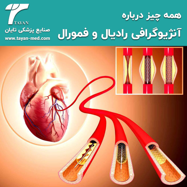  همه چیز درباره آنژیوگرافی رادیال و فمورال