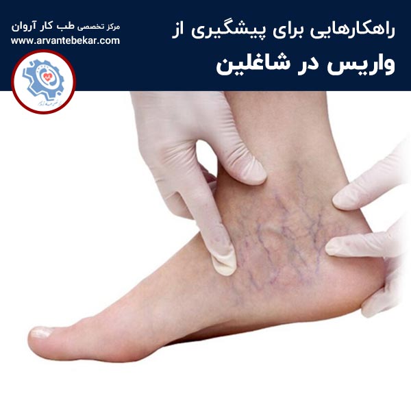  پیشگیری از واریس در شاغلین