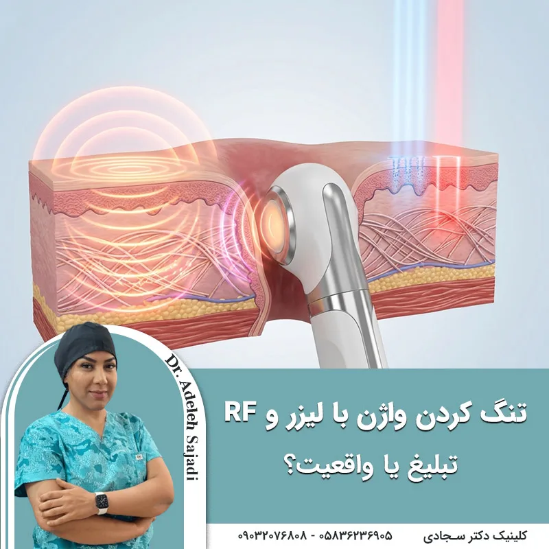 تنگ کردن واژن با لیزر و RF؛ تبلیغ یا واقعیت؟