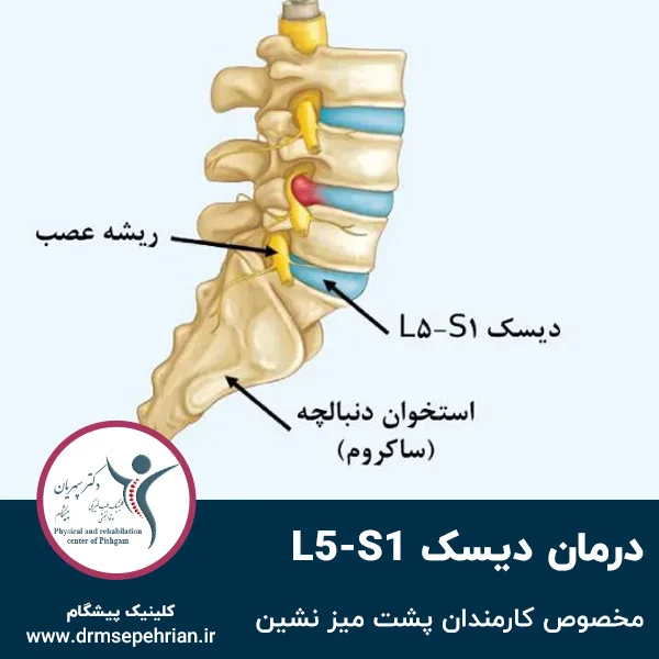 درمان دیسک L5-S1 مخصوص کارمندان پشت میز نشین