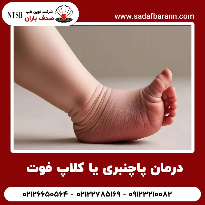 درمان پاچنبری یا کلاپ فوت