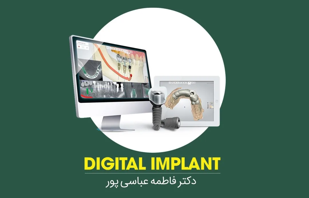 ایمپلنت دیجیتال چیست؟ همه چیز درباره ایمپلنت دیجیتال