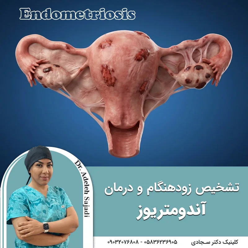 تشخیص زودهنگام و درمان های نوین آندومتریوز