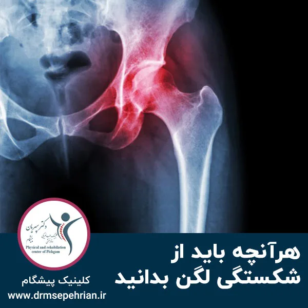 هرآنچه باید از شکستگی لگن بدانید