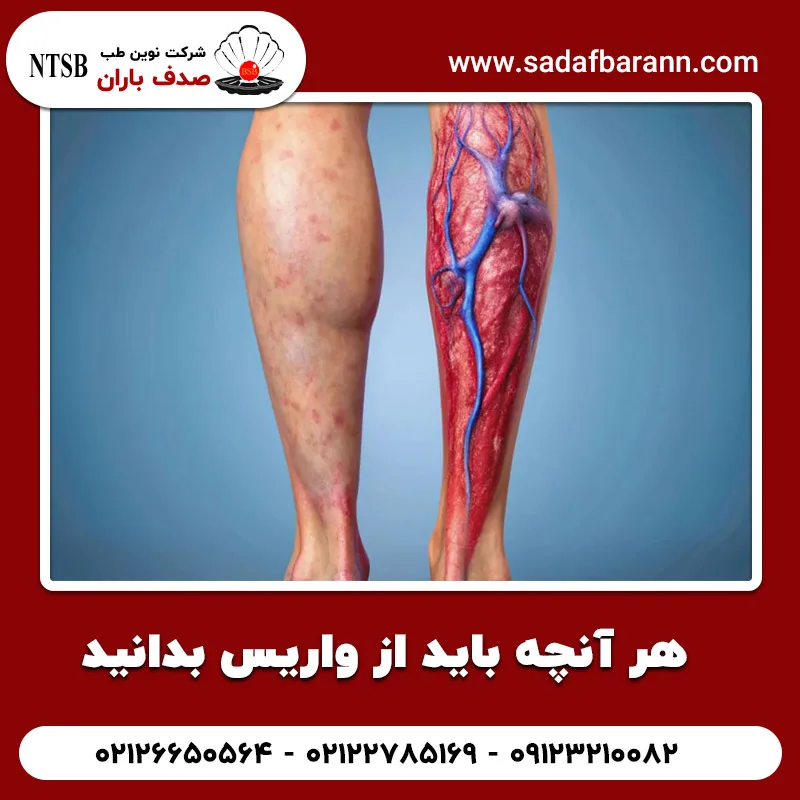 هر آنچه باید از واریس بدانید