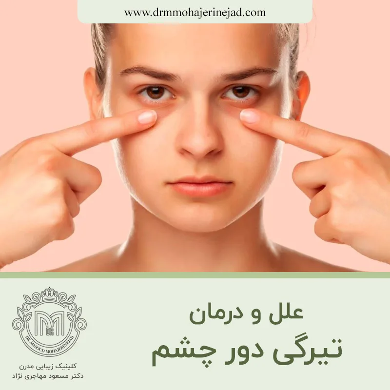 علل و درمان تیرگی دور چشم