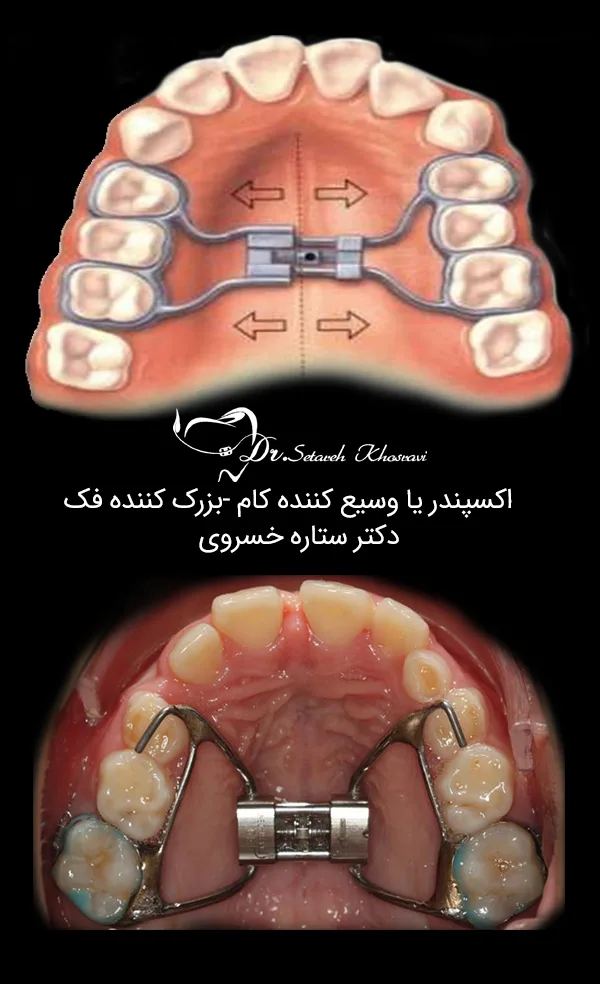 کاربرد وسیع کننده کام (گسترش دهنده فک بالا)