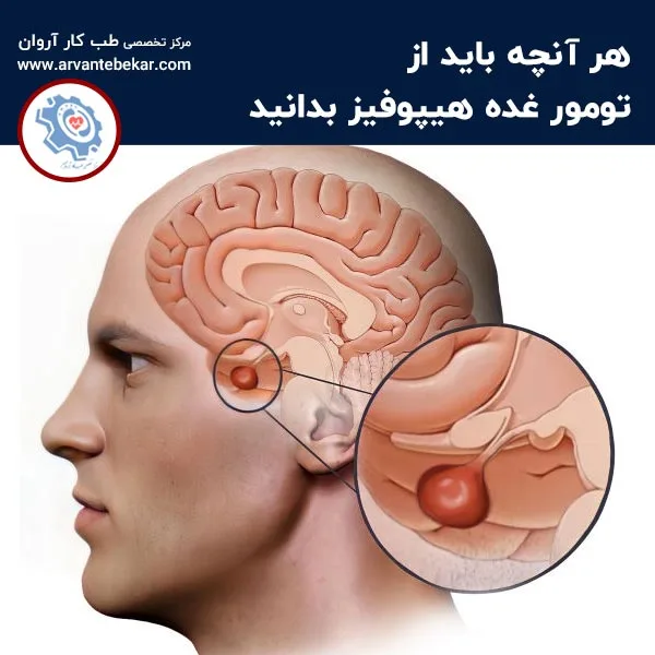 هر آنچه باید از تومور غده هیپوفیز بدانید